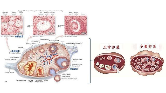 轻度的多囊卵巢综合症是能够医治的