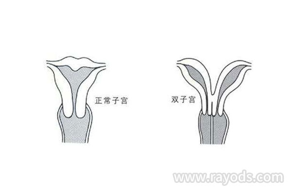 双角子宫